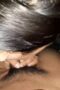 Nyepong Kehalangan Rambut Nyepong Kehalangan Rambut